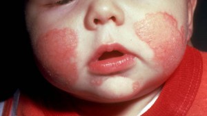 Home Remedies for Eczema baby face