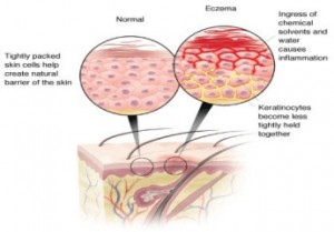 home_remedies_for_Eczema2