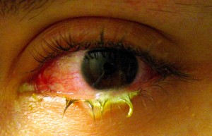 Pink Eye Pictures infected eye